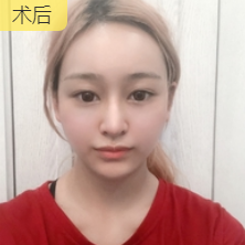 面部提升术