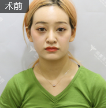 面部提升术