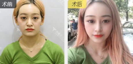 面部提升术