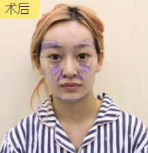面部提升术