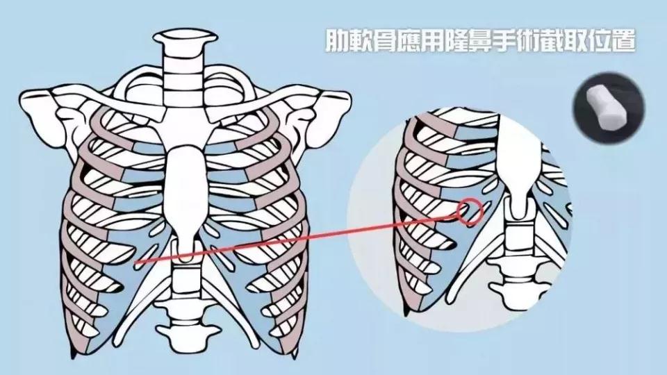 隆鼻手术