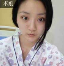 隆鼻手术