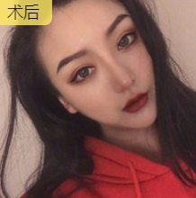 隆鼻手术