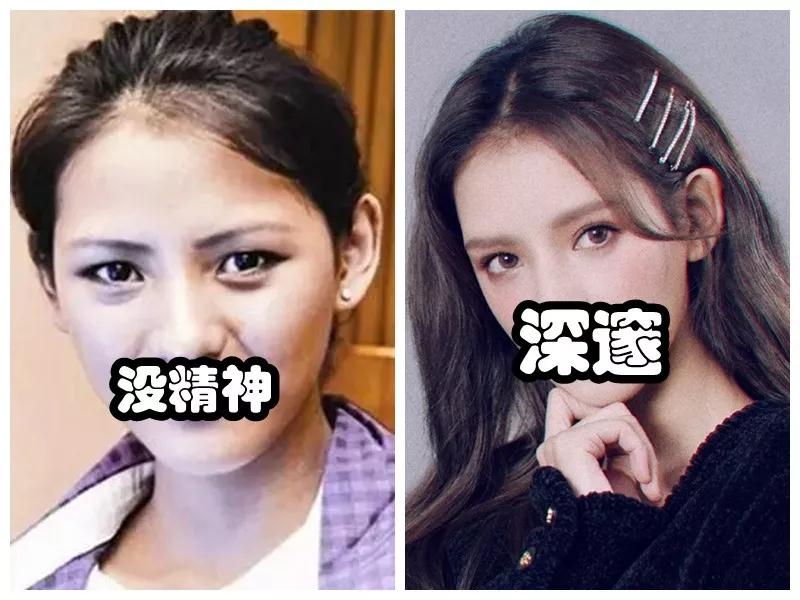 双眼皮手术