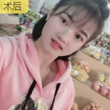 双眼皮手术