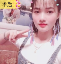 双眼皮手术