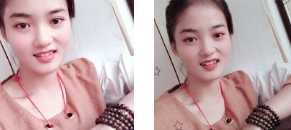 双眼皮手术