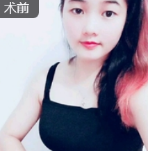 双眼皮手术