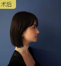 隆鼻手术