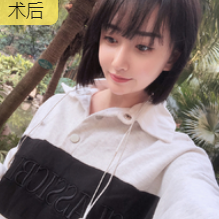 隆鼻手术