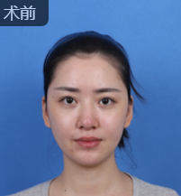 隆鼻手术