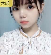 超声波瘦脸