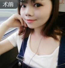 超声波瘦脸