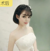 超声波瘦脸