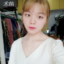 双眼皮手术