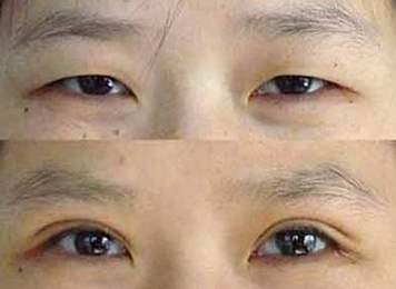 双眼皮手术