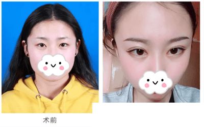双眼皮手术