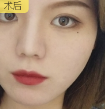 双眼皮手术
