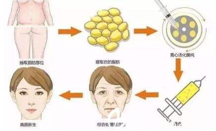 面部提升术