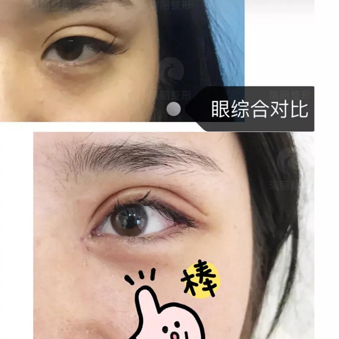双眼皮手术