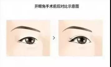 双眼皮手术