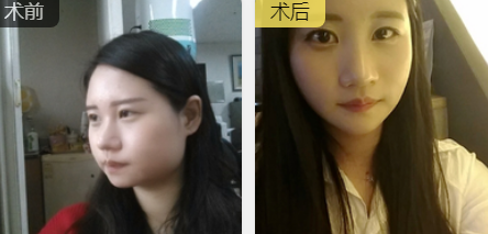 超声波瘦脸