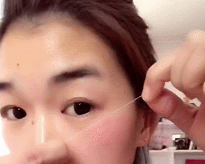 去眼袋手术