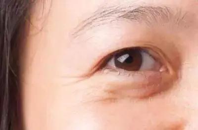 去眼袋手术