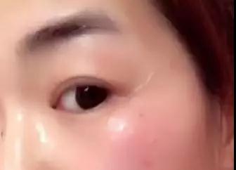 去眼袋手术
