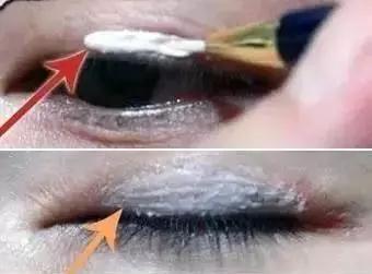 双眼皮手术