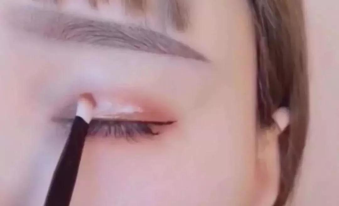 双眼皮手术