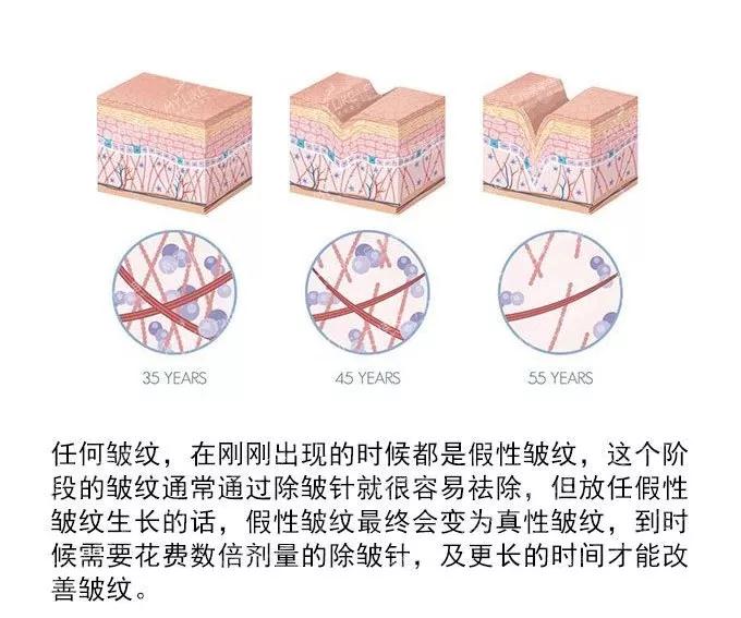 面部提升术