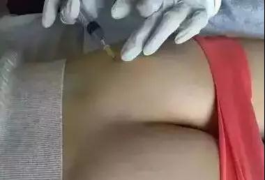 自体脂肪填充术