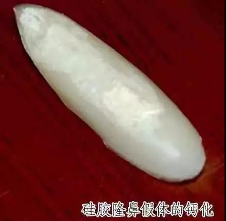 隆鼻手术