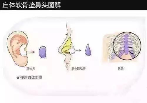 隆鼻手术