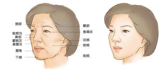 自体脂肪填充术