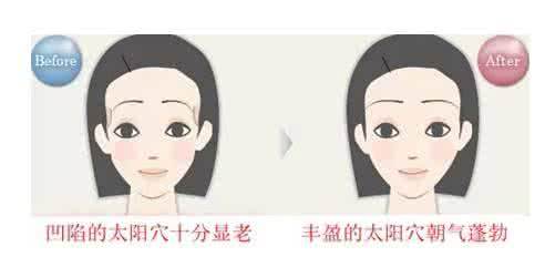 自体脂肪填充术