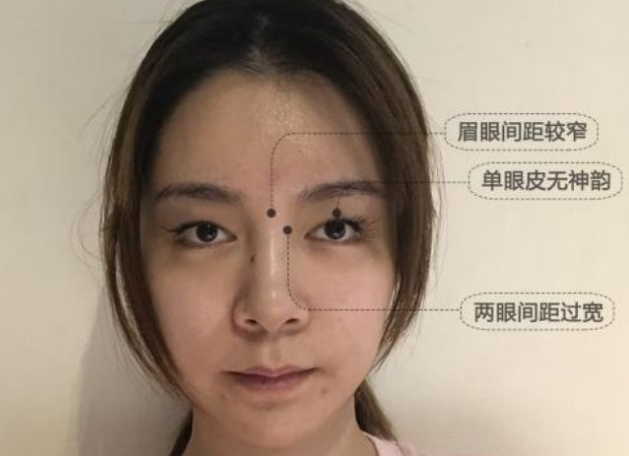 双眼皮手术