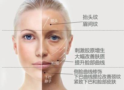 面部提升术