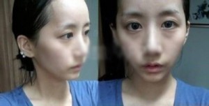 超声波去眼袋