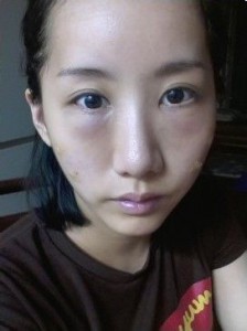 超声波去眼袋