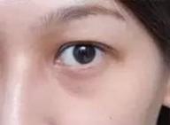 超声波去眼袋