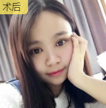 双眼皮手术