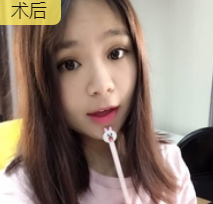 双眼皮手术