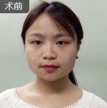 双眼皮手术
