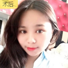 双眼皮手术