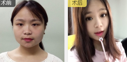 双眼皮手术
