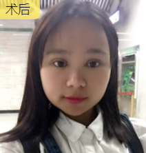 双眼皮手术