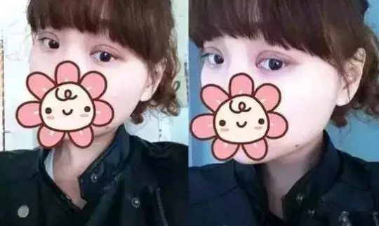 双眼皮