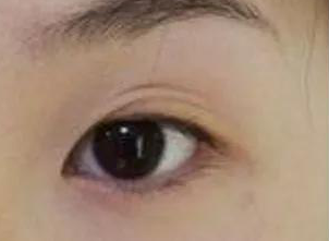 双眼皮